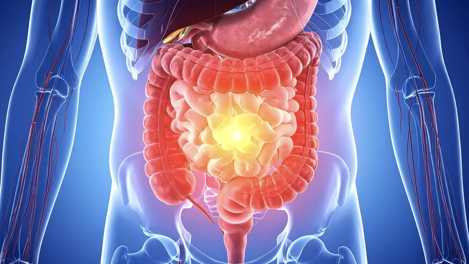 Lipedema e leaky gut: il ruolo del microbiota nel caso di una paziente dopo bypass gastrico