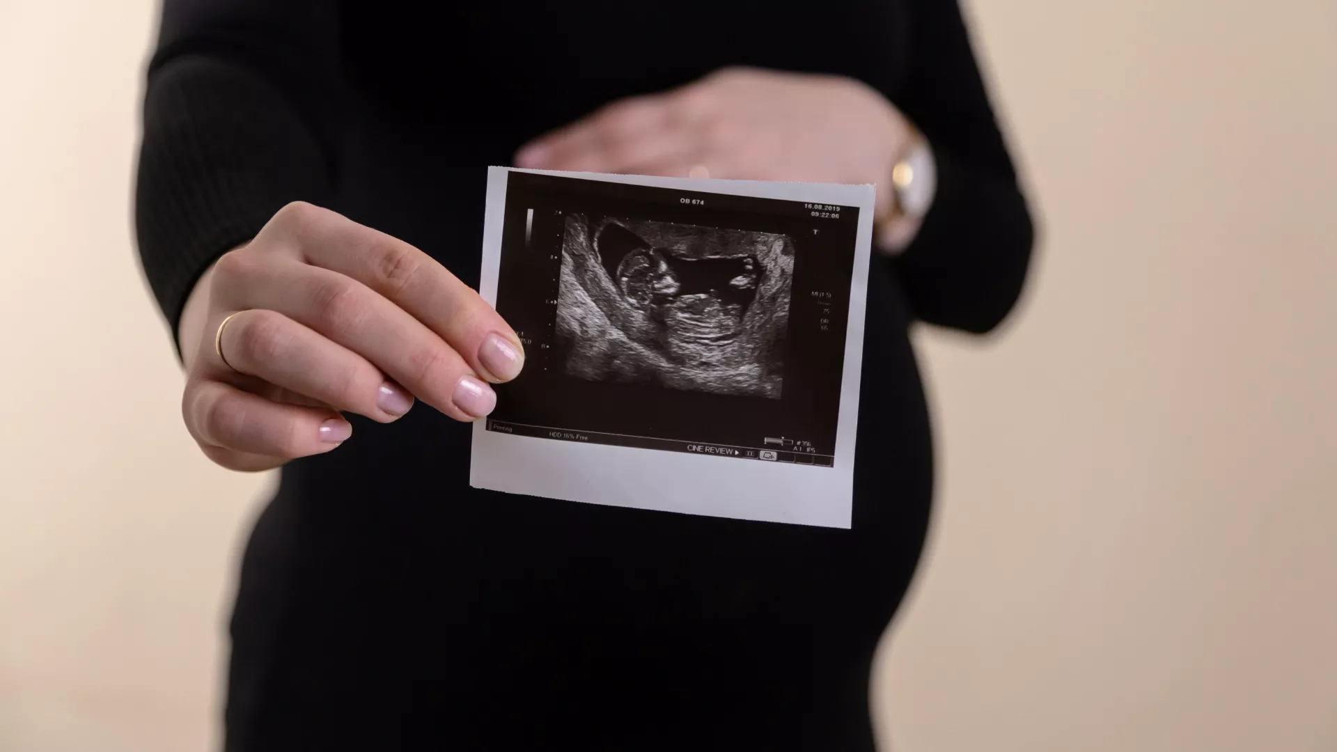 Una valutazione del microbiota vaginale dovrebbe considerare non soltanto la quantità complessiva di lattobacilli, ma anche le specie che compongono questa quota. Lactobacillus crispatus produce acido lattico ed è frequentemente associato a un pH vaginale contenuto e a una minore instabilità della comunità microbica. La sua dominanza viene quindi interpretata, nella maggior parte degli studi, come una configurazione favorevole. Lactobacillus iners presenta invece caratteristiche differenti. Può essere rilevato sia in condizioni considerate fisiologiche sia durante fasi di transizione verso una disbiosi o dopo un trattamento antibiotico. Le comunità dominate da L. iners sembrano meno resistenti alle variazioni ambientali e possono modificarsi più facilmente in seguito a cambiamenti ormonali, mestruazioni, rapporti sessuali o terapie farmacologiche. La semplice dicitura “microbiota dominato da lattobacilli” può quindi risultare poco informativa quando non viene specificata la specie prevalente. La letteratura suggerisce una maggiore capacità protettiva per L. crispatus rispetto a L. iners, senza però attribuire a una singola specie un valore diagnostico indipendente dal quadro clinico